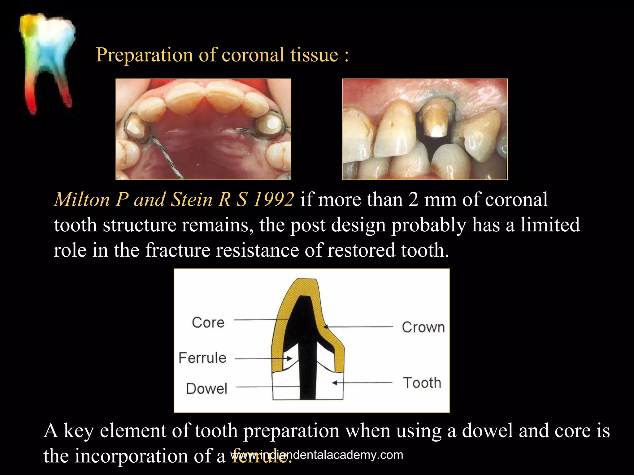 Preparation of coronal tissue :

Milton P and Stein R S 1992 if more than 2 mm of coronal
tooth structure remains, the post design probably has a limited
role in the fracture resistance of restored tooth.

A key element of tooth preparation when using a dowel and core is
the incorporation of a www.indiandentalacademy.com
ferrule.

 