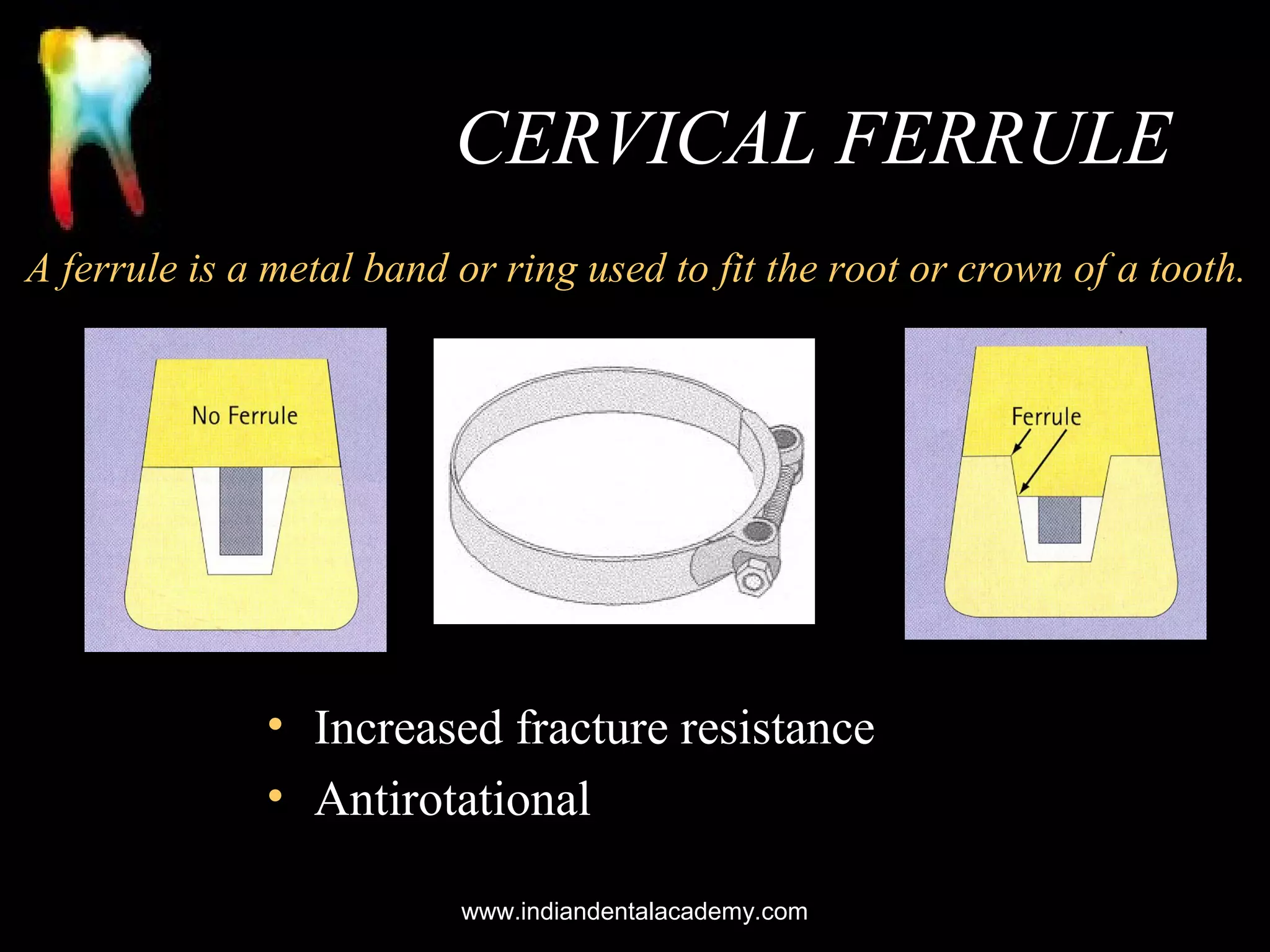 CERVICAL FERRULE
A ferrule is a metal band or ring used to fit the root or crown of a tooth.

• Increased fracture resistance
• Antirotational
www.indiandentalacademy.com

 