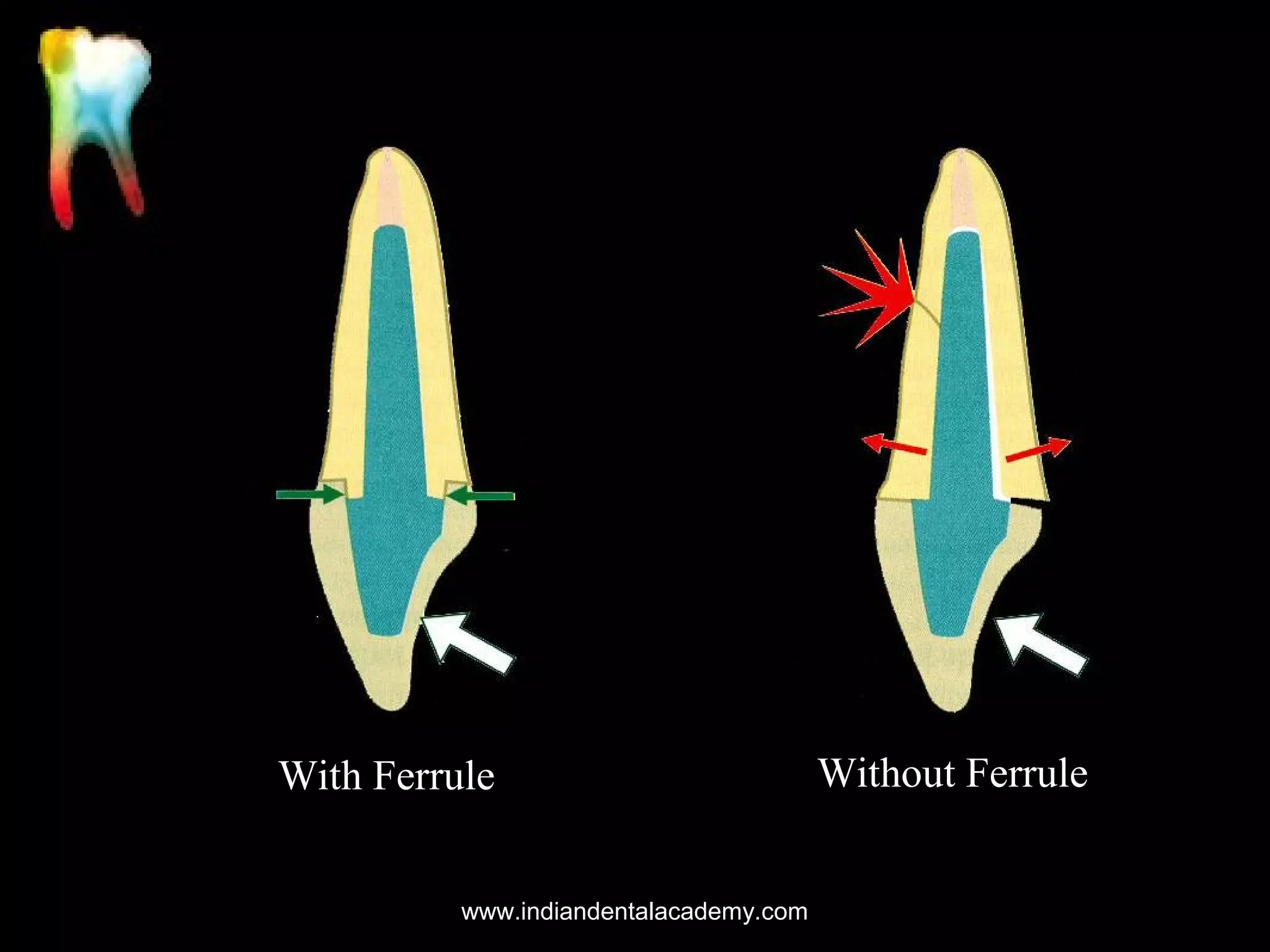 With Ferrule
www.indiandentalacademy.com

Without Ferrule

 