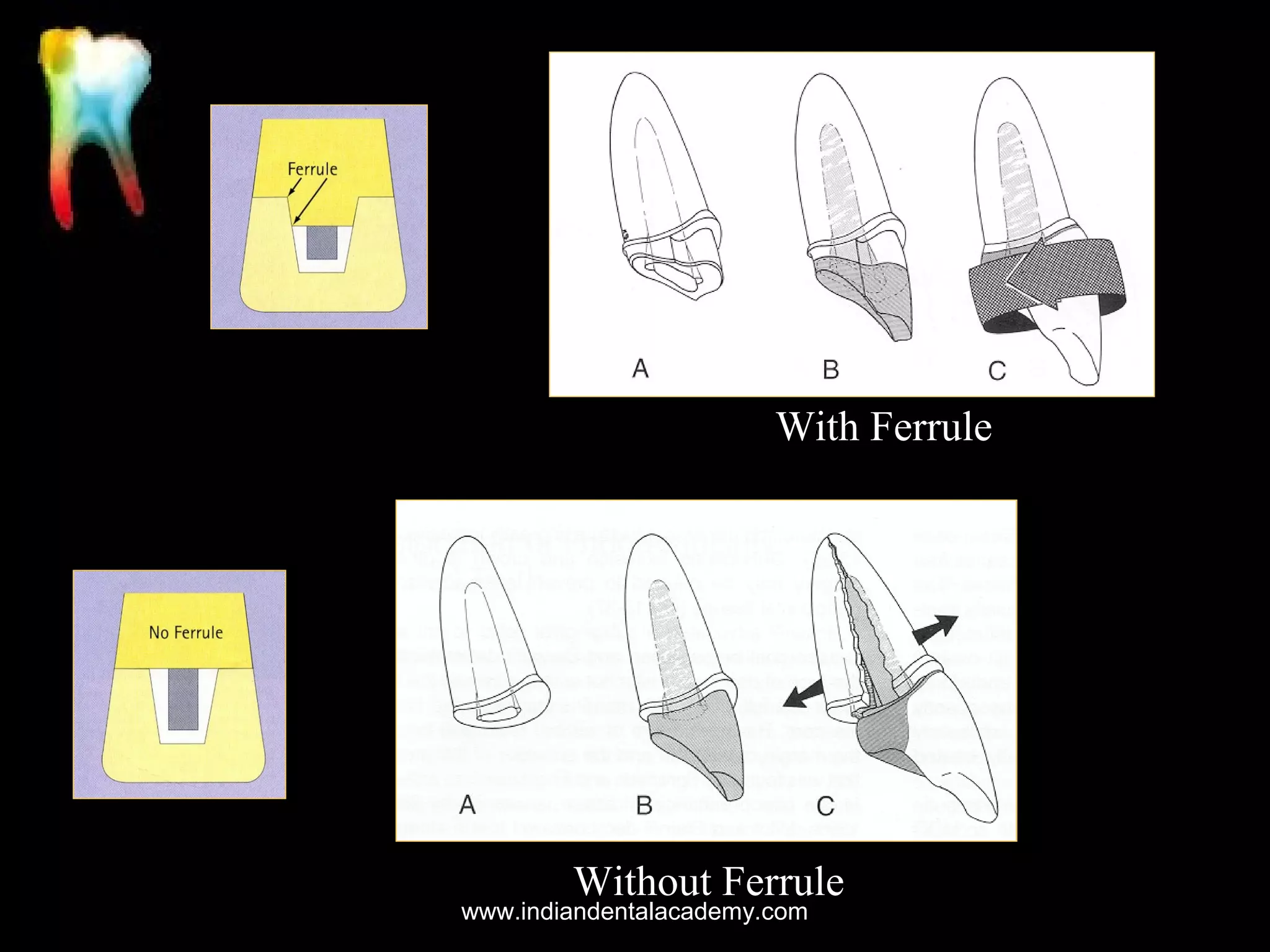 With Ferrule

Without Ferrule

www.indiandentalacademy.com

 