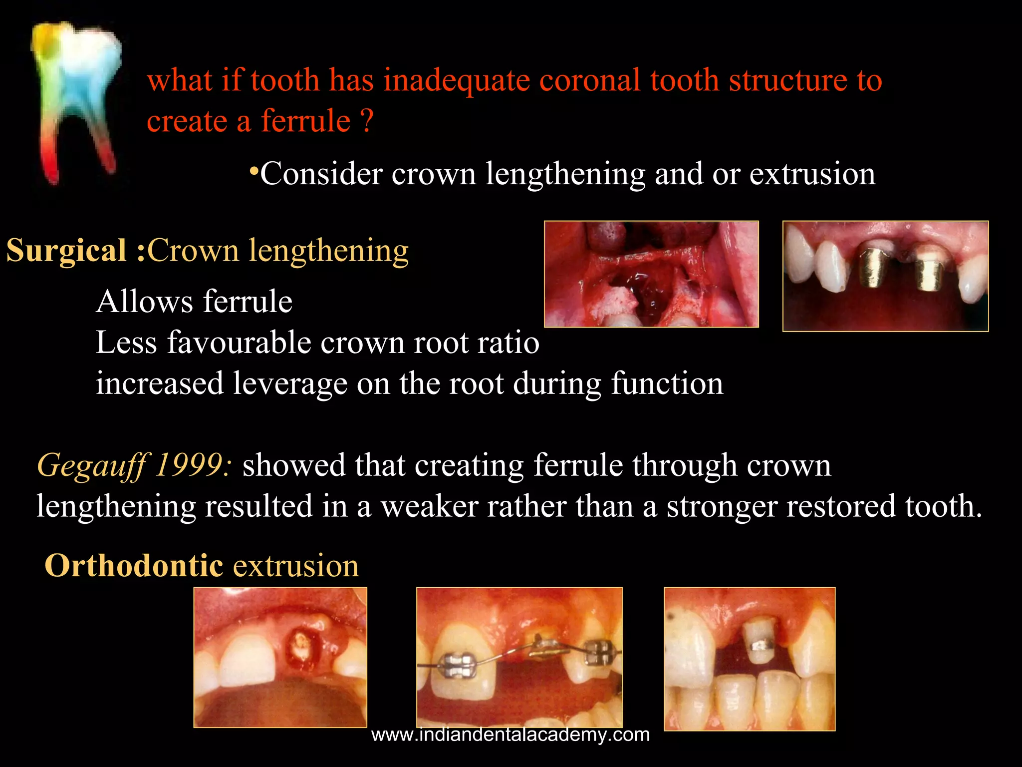 what if tooth has inadequate coronal tooth structure to
create a ferrule ?
•Consider crown lengthening and or extrusion
Surgical :Crown lengthening
Allows ferrule
Less favourable crown root ratio
increased leverage on the root during function
Gegauff 1999: showed that creating ferrule through crown
lengthening resulted in a weaker rather than a stronger restored tooth.
Orthodontic extrusion

www.indiandentalacademy.com

 