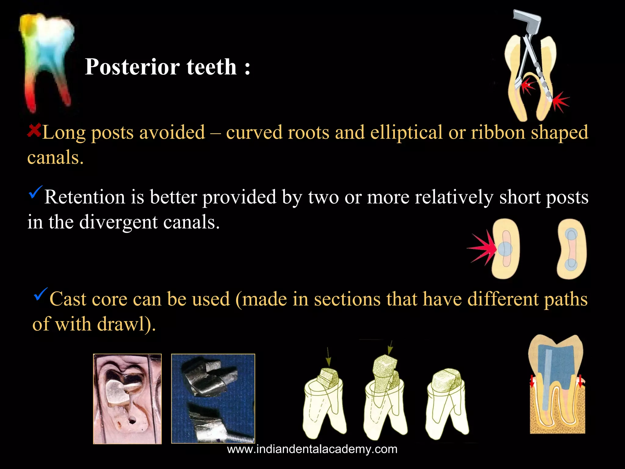 Posterior teeth :
Long posts avoided – curved roots and elliptical or ribbon shaped
canals.
Retention is better provided by two or more relatively short posts
in the divergent canals.

Cast core can be used (made in sections that have different paths
of with drawl).

www.indiandentalacademy.com

 