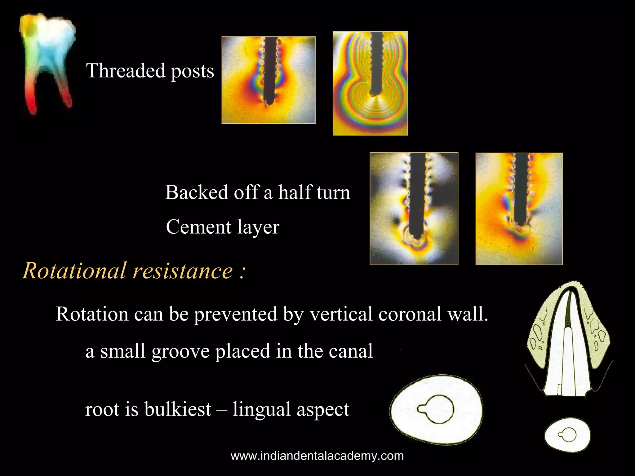 Threaded posts

Backed off a half turn
Cement layer

Rotational resistance :
Rotation can be prevented by vertical coronal wall.
a small groove placed in the canal
root is bulkiest – lingual aspect
www.indiandentalacademy.com

 
