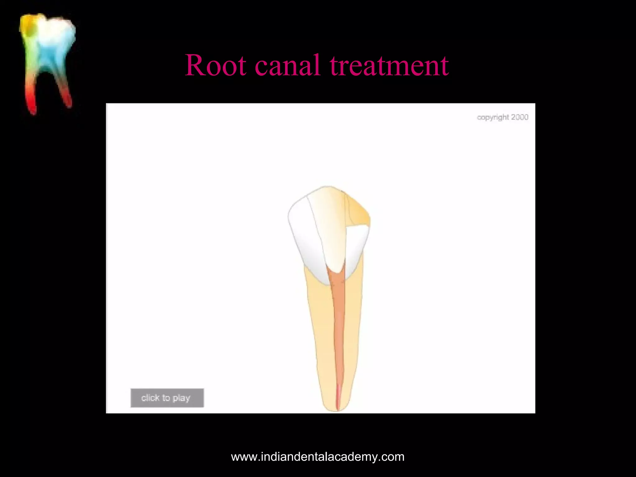 Root canal treatment

www.indiandentalacademy.com

 