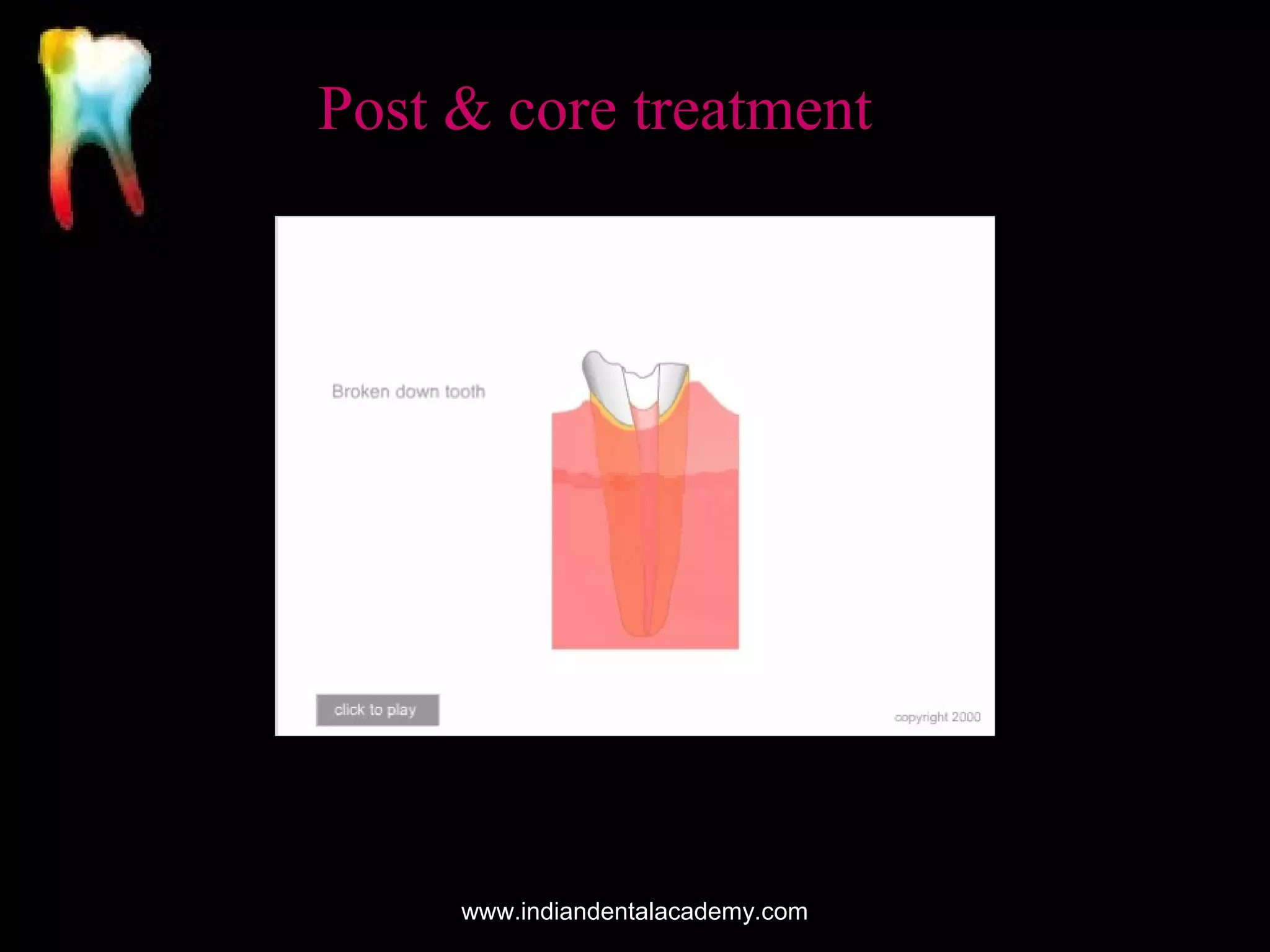 Post & core treatment

www.indiandentalacademy.com

 