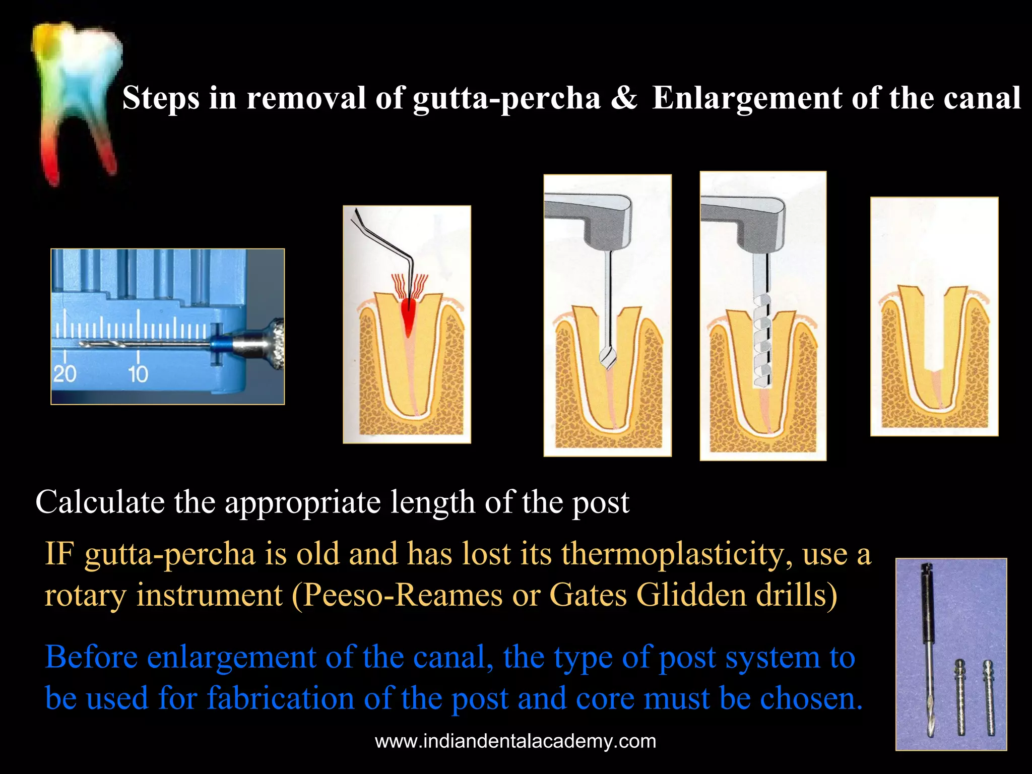 Steps in removal of gutta-percha & Enlargement of the canal

Calculate the appropriate length of the post
IF gutta-percha is old and has lost its thermoplasticity, use a
rotary instrument (Peeso-Reames or Gates Glidden drills)
Before enlargement of the canal, the type of post system to
be used for fabrication of the post and core must be chosen.
www.indiandentalacademy.com

 