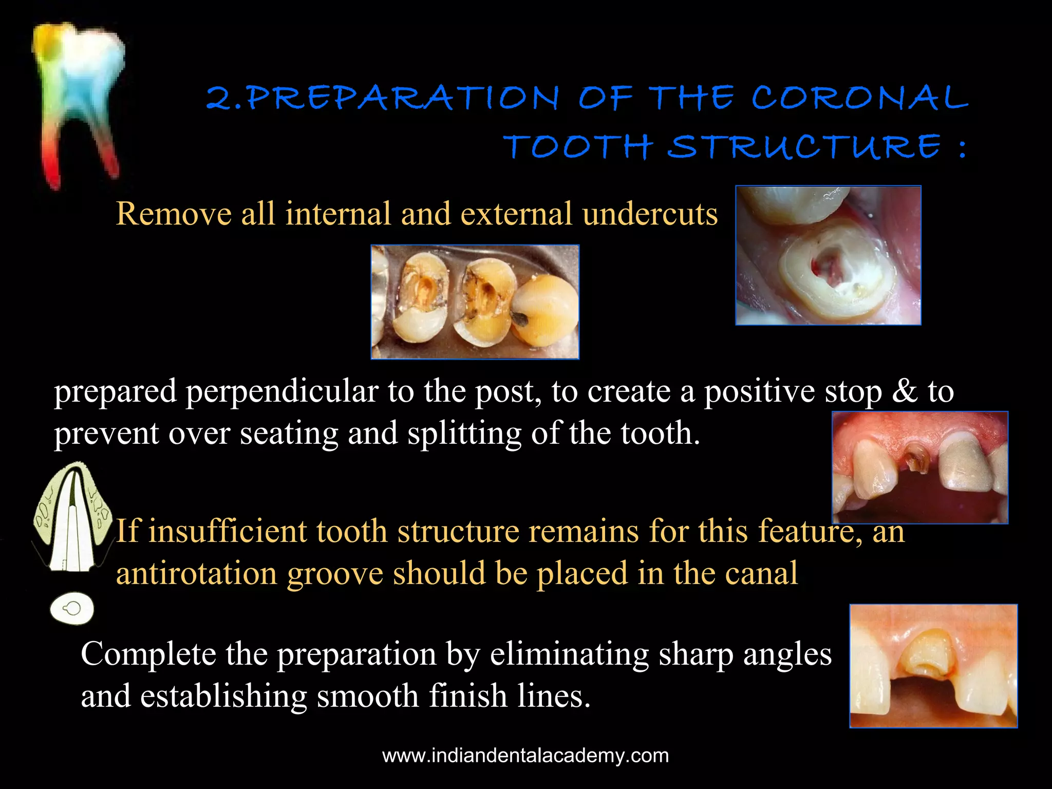 2.PREPARATION OF THE CORONAL
TOOTH STRUCTURE :
Remove all internal and external undercuts

prepared perpendicular to the post, to create a positive stop & to
prevent over seating and splitting of the tooth.
If insufficient tooth structure remains for this feature, an
antirotation groove should be placed in the canal
Complete the preparation by eliminating sharp angles
and establishing smooth finish lines.
www.indiandentalacademy.com

 
