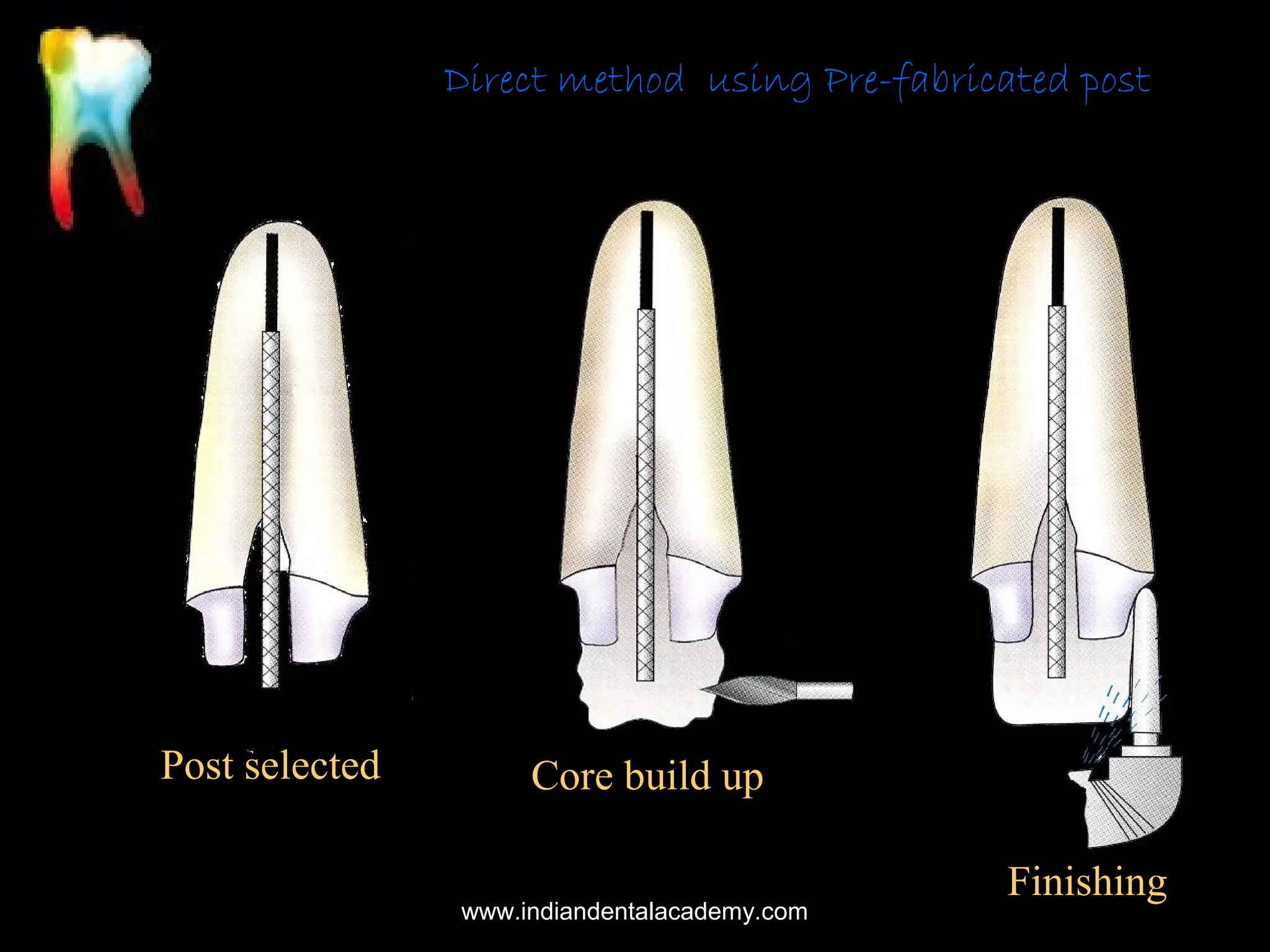 Direct method using Pre-fabricated post

Post selected

Core build up
www.indiandentalacademy.com

Finishing

 
