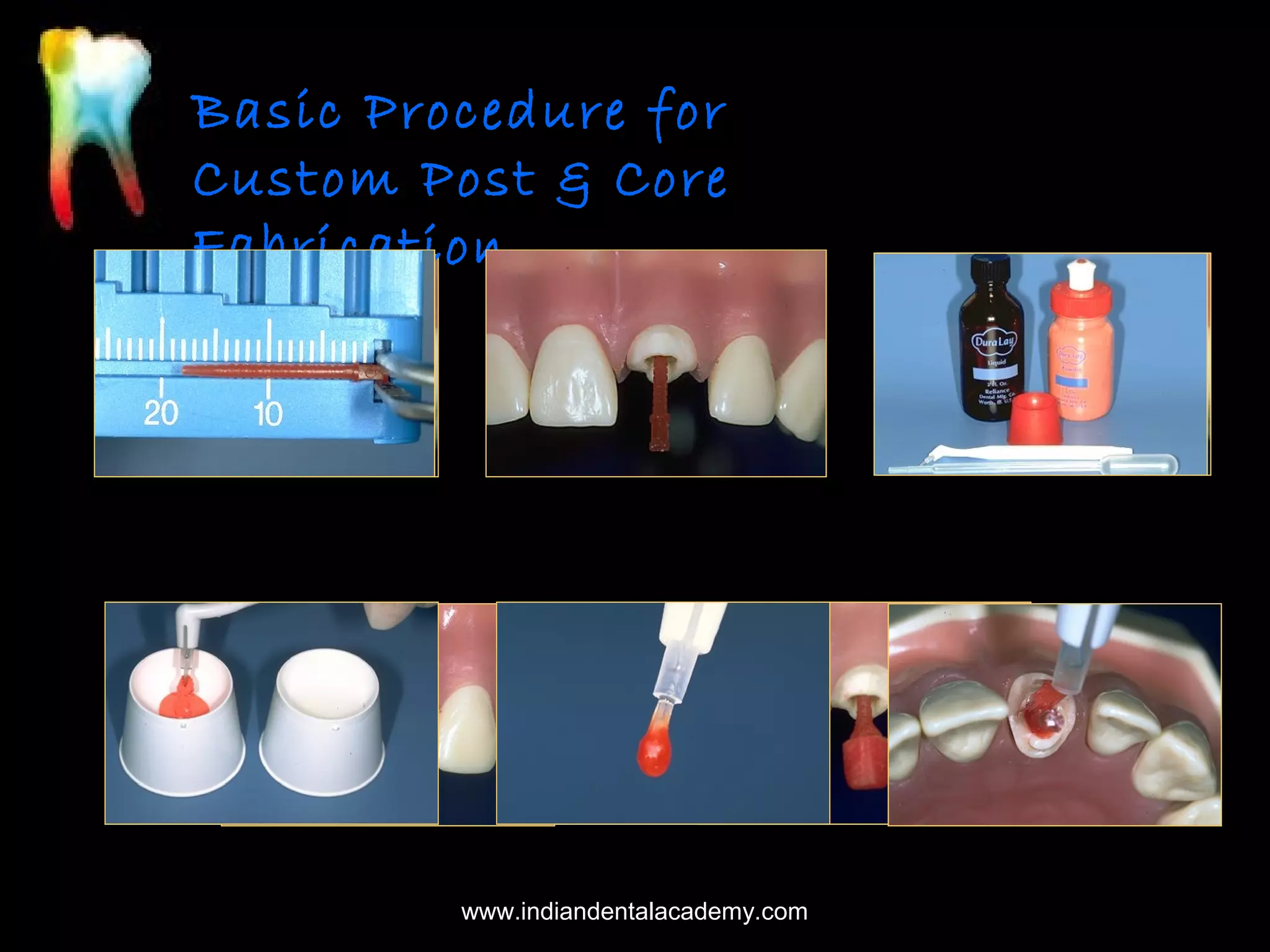 Basic Procedure for
Custom Post & Core
Fabrication

www.indiandentalacademy.com

 
