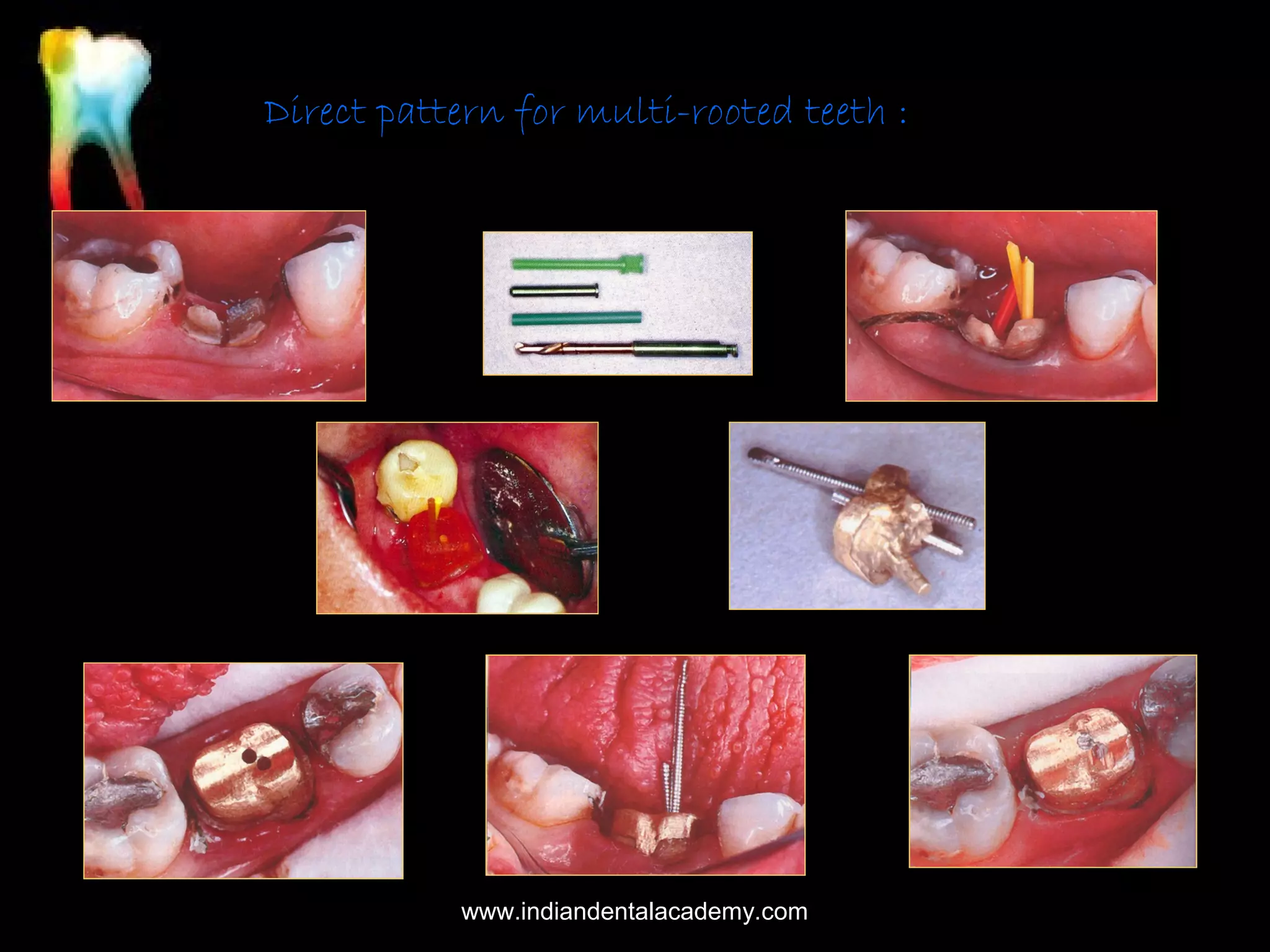 Direct pattern for multi-rooted teeth :

www.indiandentalacademy.com

 