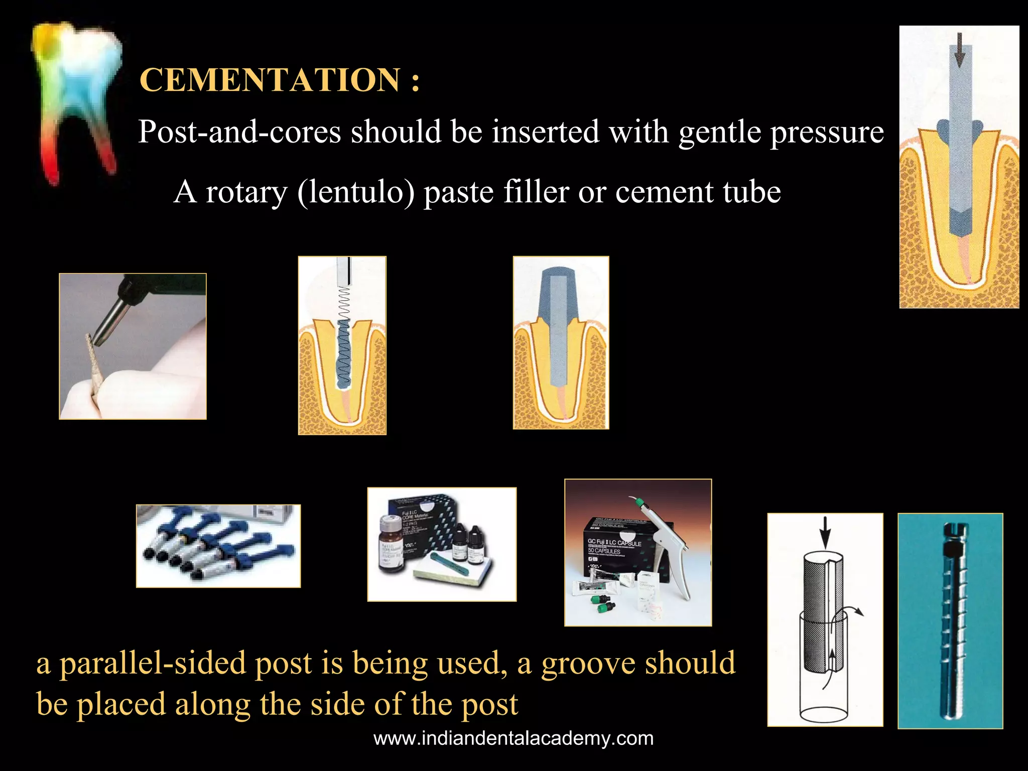 CEMENTATION :
Post-and-cores should be inserted with gentle pressure
A rotary (lentulo) paste filler or cement tube

a parallel-sided post is being used, a groove should
be placed along the side of the post
www.indiandentalacademy.com

 