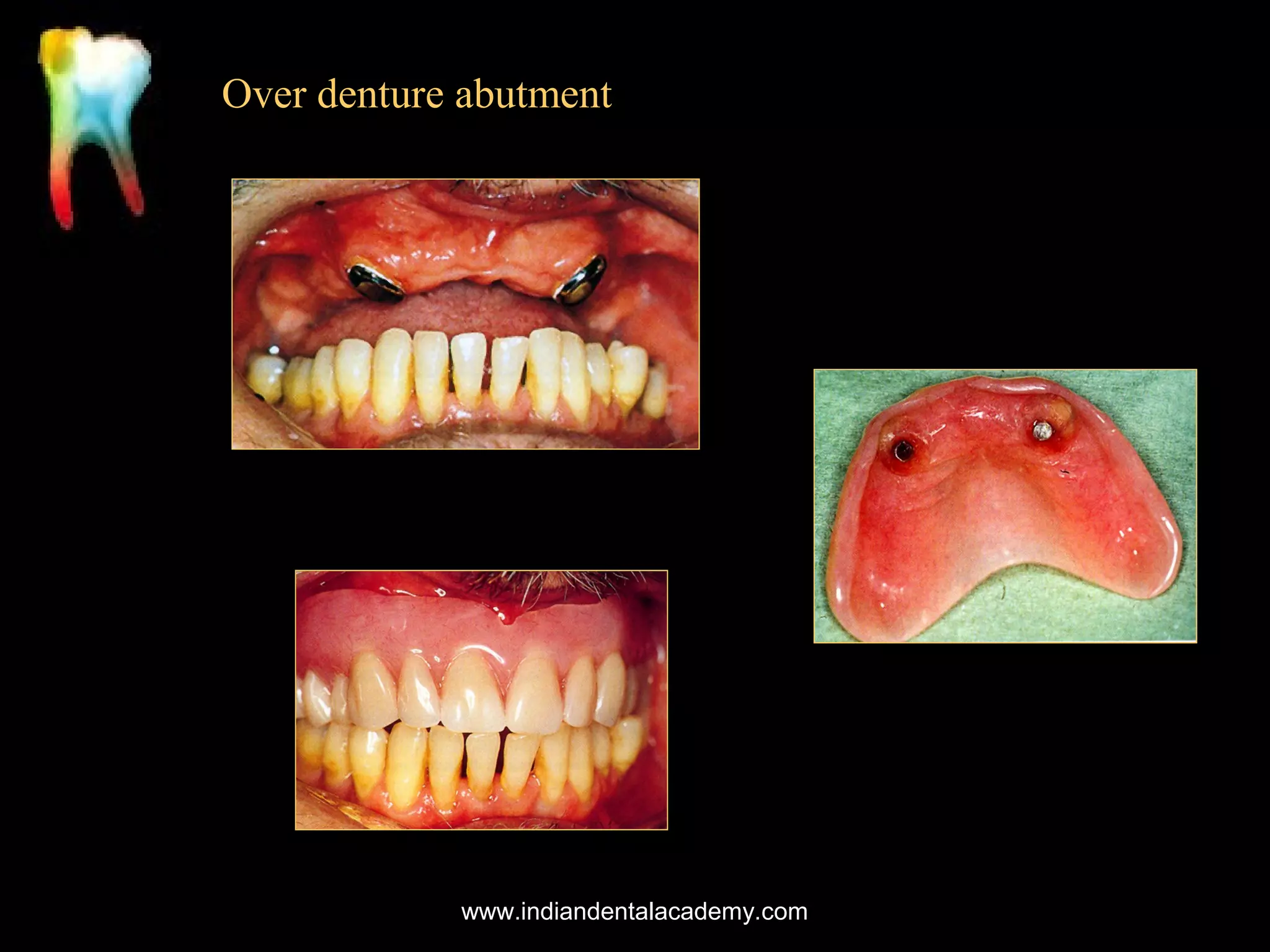 Over denture abutment

www.indiandentalacademy.com

 