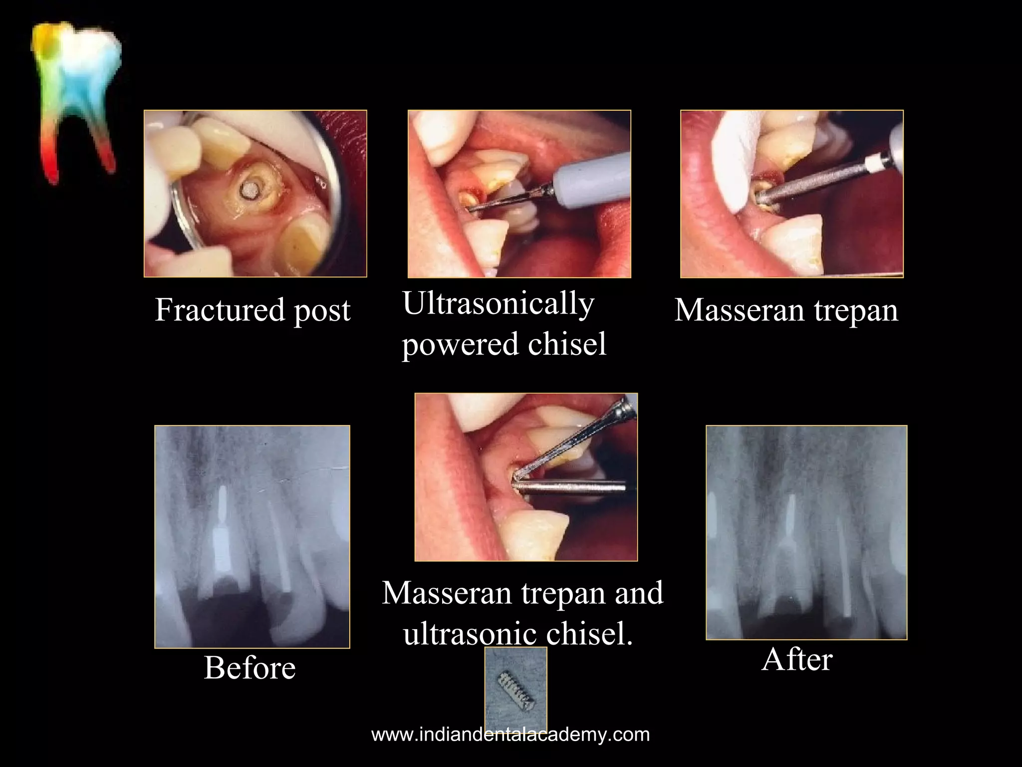 Fractured post

Before

Ultrasonically
powered chisel

Masseran trepan and
ultrasonic chisel.
www.indiandentalacademy.com

Masseran trepan

After

 