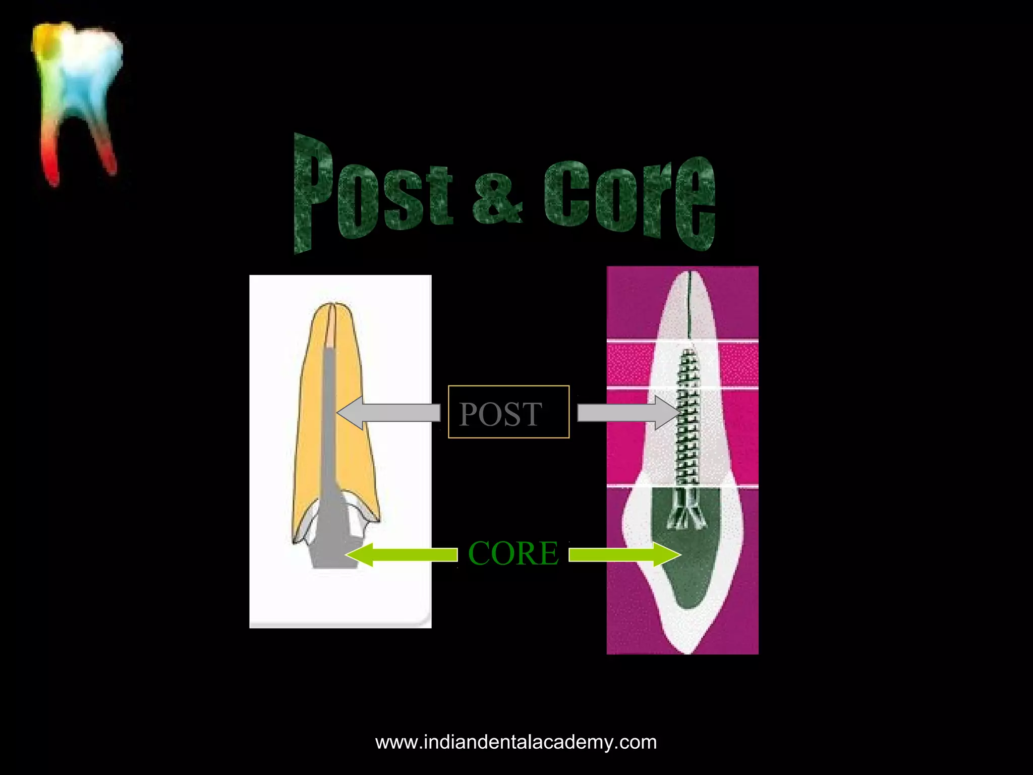 POST

CORE

www.indiandentalacademy.com

 