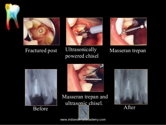 Problem Solving In Endodontics Gutmann Free Problem Solving In Endodontics Gutmann Free