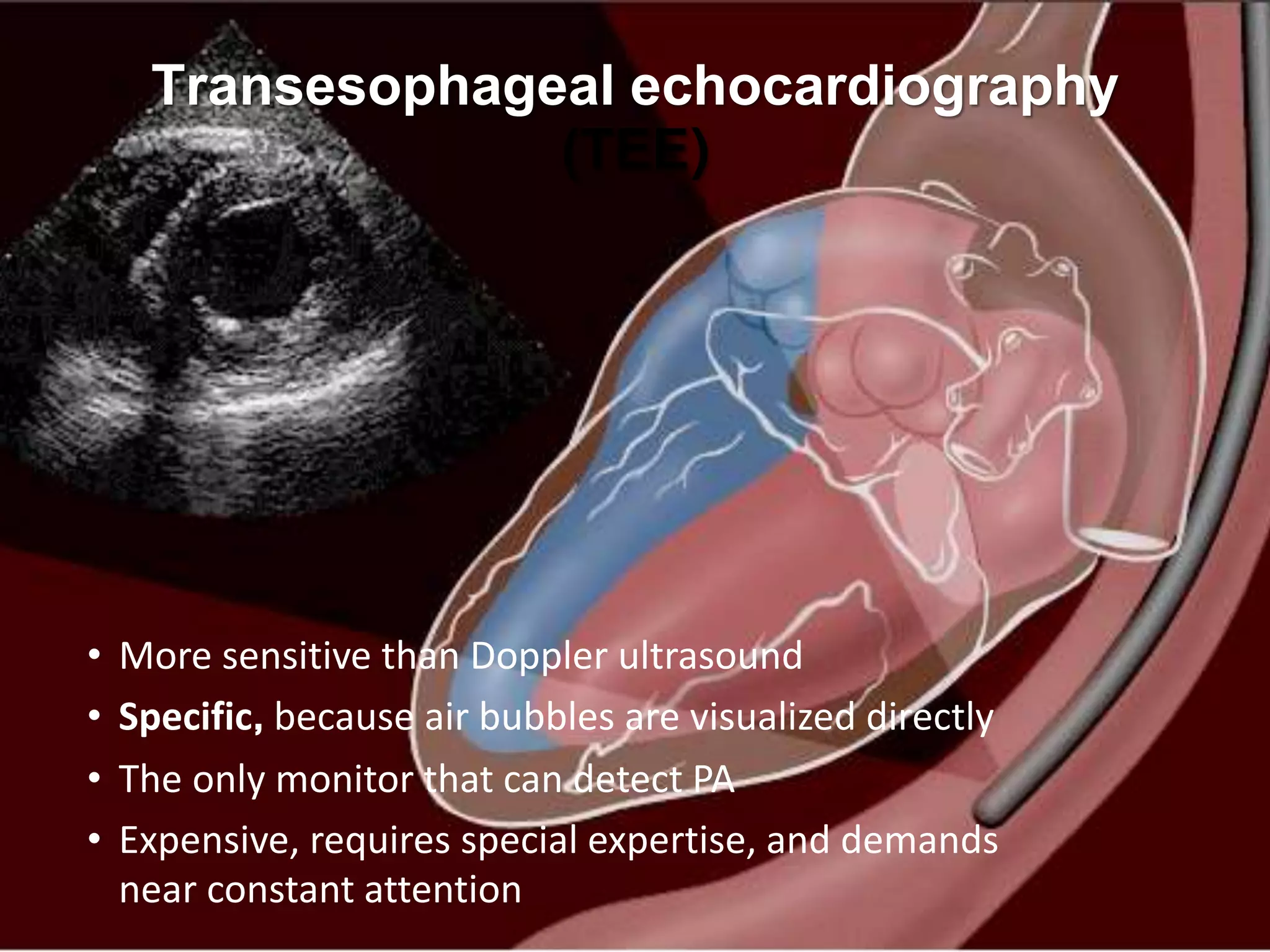 Transesophageal echocardiography
(TEE)
• More sensitive than Doppler ultrasound
• Specific, because air bubbles are visualized directly
• The only monitor that can detect PA
• Expensive, requires special expertise, and demands
near constant attention
 