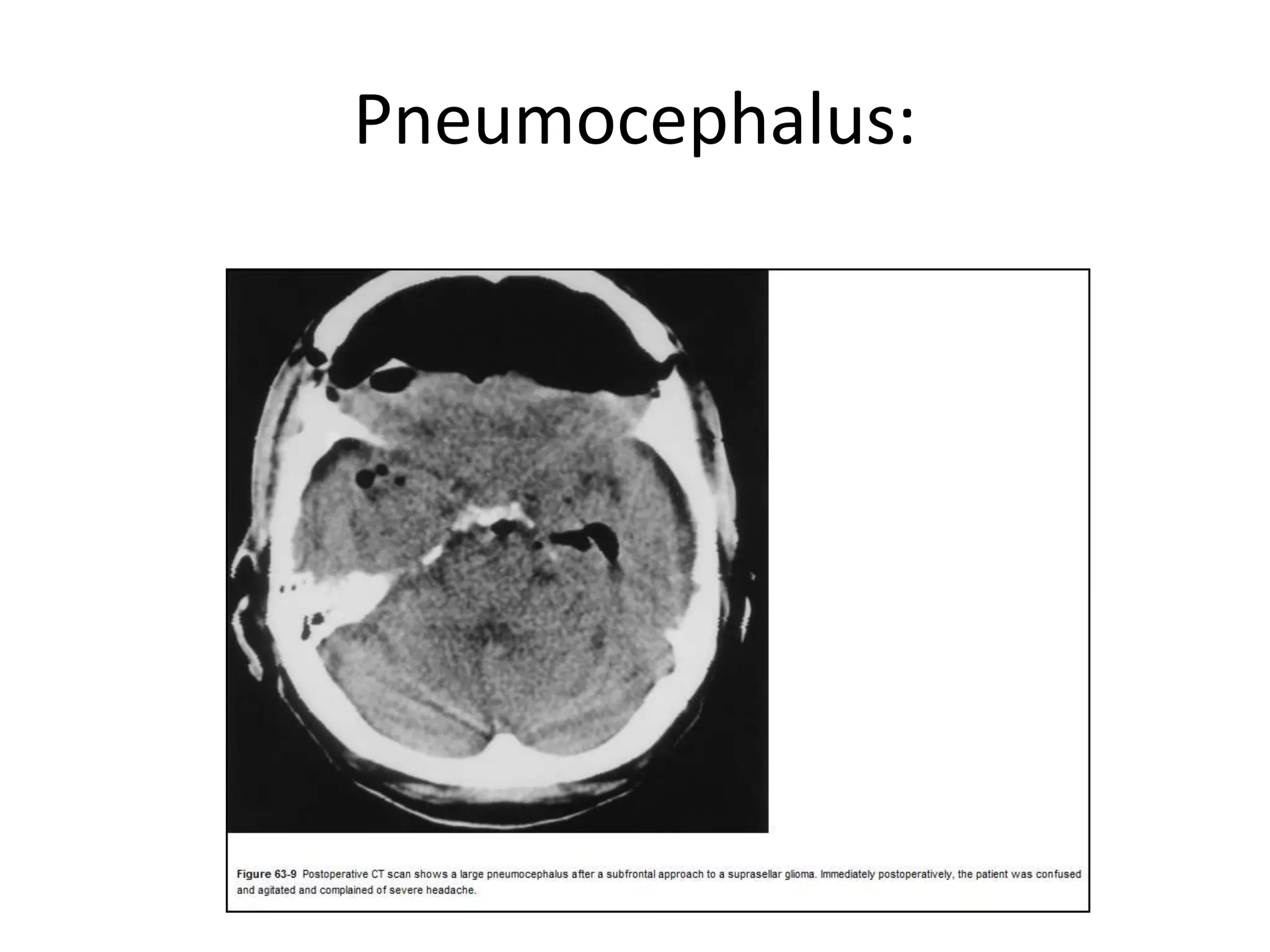 Pneumocephalus:
 