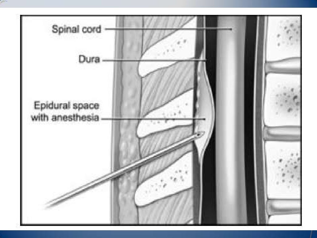 Post Dural Puncture Headache