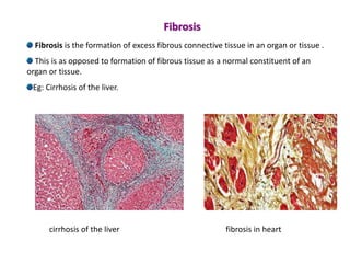 Fibrosis is the formation of excess fibrous connective tissue in an organ or tissue .
This is as opposed to formation of fibrous tissue as a normal constituent of an
organ or tissue.
Eg: Cirrhosis of the liver.
cirrhosis of the liver fibrosis in heart
Fibrosis
 