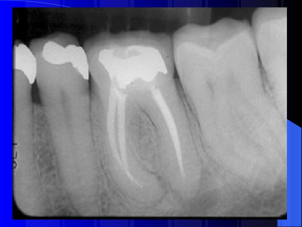 Post endodontic treatment_disease
