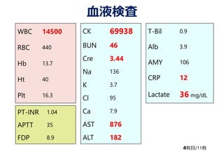 ѪҺʖ
WBC 14500
RBC 440
Hb 13.7
Ht 40
Plt 16.3
4öĿ/11ö
CK 69938
BUN 46
Cre 3.44
Na 136
K 3.7
Cl 95
Ca 7.9
AST 876
ALT 182
PT-INR 1.04
APTT 35
FDP 8.9
T-Bil 0.9
Alb 3.9
AMY 106
CRP 12
Lactate 36 mg/dL
 