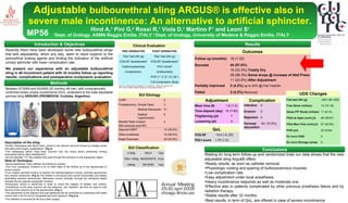 Conclusions Results Adjustable  bulbourethral sling ARGUS ®  is effective also in  severe male incontinence: An alternative to artificial sphincter.   Hind A, 1  Pini G, 2  Rossi R, 1  Viola D, 1  Martino F 1  and Leoni S 1     1 Dept. of Urology, ASMN Reggio Emilia ,  ITALY   2  Dept. of Urology, University of Modena & Reggio Emilia, ITALY Introduction & Objectives Methods Between 07/2006 and 03/2009 (32 months) 48 men, with urodynamically confirmed stress urinary incontinence (SUI), underwent to the male adjustable perineal sling  ARGUS® (PROMEDON, Cordoba, Argentina ). Recently there have been developed some new bulbourethral slings that lack adjustability, which any way, seem to result superior to the periurethral bulking agents and limiting the indication of the artificial urinary sphincter with lower complication rate. We present our experience with an adjustable bulbourethral sling in 48 incontinent patient with 32 months follow up reporting results, complications and postoperative urodynamic evaluation. ,[object Object],[object Object],[object Object],[object Object],[object Object],[object Object],[object Object],[object Object],[object Object],[object Object],[object Object],[object Object],[object Object],[object Object],[object Object],[object Object],[object Object],[object Object],[object Object],[object Object],a b c MP56 d e *ICIQ-SF: International Consultation on Incontinence - Short Form (score 0-21) # PGI-I score: Patient Global Impression of Improvement (Score 1-7) Complication Infection 0 Erosion 0 Rejection 0 Perineal disconfort 18 ( 37,5%)  Clinical Evaluation PRE-OPERATIVE POST-OPERATIVE Pad Test 24h (g) Pad Test 24h (g) ICIQ-SF Questionaire* ICIQ-SF Questionaire* Urethrocystoscopy PGI-I score # Urodynamics  Uroflowmetry PVR (1°,3°,6°,12°,24°) Full Urodynamic Study SUI Etiology TURP 2 Prostatectomy Simple Open  3 Radical Retropubic 31 Radical Laparoscopic 8 Bladder Neck Incision  (BN sclerosis post RP) 4 Adjuvant EBRT 14 (29.2%) Other prosthesis 14 (29.2%) Kegel Exercises 22 (45.8%) SUI Classification ≤ 150g MILD 13pz 150≥ >400g MODERATE 21pz ≥ 400g SEVERE 14pz Outcomes Follow up (months) 18 (1-32) Success 44 (91.6%) 16 (33.3%)  Totally Dry 28 (58.3%)  Some drops @ increase of Abd Press 11 (22.9%)  After Adjustment Partially Improved 2 (4.2%)  up to 50% @ Pad Test24h Failed 2 (4.2%)  Removed QoL ICIQ-SF -15,4 (-9,-20) PGI-I score 1,75 (1-4) Adjustment Mean time (#) 1,9 (1-3) Time elapsed (day) 15 (7-65) Thightening (pt) 7 Loosening (pt) 4 