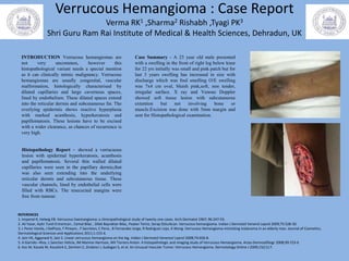 Verrucous Hemangioma : Case Report
Verma RK1 ,Sharma2 Rishabh ,Tyagi PK3
Shri Guru Ram Rai Institute of Medical & Health Sciences, Dehradun, UK
Case Summary - A 23 year old male presented
with a swelling in the front of right leg below knee
for 22 yrs initially was small and pink patch but for
last 3 years swelling has increased in size with
discharge which was foul smelling O/E swelling
was 7x4 cm oval, bluish pink,soft, non tender,
irregular surface. X ray and Venous Doppler
showed soft tissue lesion with subcutaneous
extention but not involving bone or
muscle.Excision was done with 5mm margin and
sent for Histopathological examination.
Histopathology Report – showed a verrucuous
lesion with epidermal hyperkeratosis, acanthosis
and papillomatosis. Several thin walled dilated
capillaries were seen in the papillary dermis,that
was also seen extending into the underlying
reticular dermis and subcutaneous tissue. These
vascular channels, lined by endothelial cells were
filled with RBCs. The resecected margins were
free from tumour.
REFERENCES
1. Imperial R, Helwig EB. Verrucous haemangioma: a clinicopathological study of twenty one cases. Arch Dermatol 1967; 96:247-53.
2. Ali Yasar, Aylin Turel Ermertcan , Cemal Bilac , Dilek Bayraktar Bilac, Peyker Temiz, Serap Ozturkcan. Verrucous hemangioma. Indian J Dermatol Venerol Leprol 2009;75:528-30.
3. L Perez Varela, J DelPozo, F Pineyro , F Sacristan, C Pena , B Fernandez Jorge, R Rodriguez Lojo, A Wong. Verrucous Hemangioma mimicking melanoma in an elderly man. Journal of Cosmetics,
Dermatological Sciences and Applications 2011;1:153-6.
4. Jain VK, Aggarwal K, Jain S. Linear verrucous hemangioma on the leg. Indian J Dermatol Venereol Leprol 2008;74:656-8.
5. A Garrido –Rios, L Sanchez Velicia, JM Marinio Harrison, MV Torrero Anton. A histopathologic and imaging study of Verrucous Hemangioma. Actas Dermosifiliogr 2008;99:723-6
6. Koc M, Kavala M, Kocatürk E, Zemheri E, Zindanci I, Sudogan S, et al. An Unusual Vascular Tumor: Verrucous Hemangioma. Dermatology Online J 2009;15(11):7.
INTRODUCTION Verrucous hemangiomas are
not very uncommon, however this
histopathological variant needs a special mention
as it can clinically mimic malignancy. Verrucous
hemangiomas are usually congenital, vascular
malformation, histologically characterised by
dilated capillaries and large cavernous spaces,
lined by endothelium. These dilated spaces extend
into the reticular dermis and subcutaneous fat. The
overlying epidermis shows reactive hyperplasia
with marked acanthosis, hyperkeratosis and
papillomatosis. These lesions have to be excised
with a wider clearance, as chances of recurrence is
very high.
 
