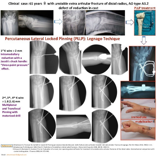 Percutaneous Lateral Locked Pinning of extra articular distal radius