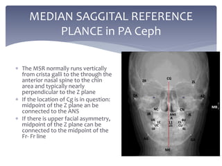 The MSR normally runs vertically
from crista galli to the through the
anterior nasal spine to the chin
area and typically nearly
perpendicular to the Z plane
 If the location of Cg is in question:
midpoint of the Z plane an be
connected to the ANS
 If there is upper facial asymmetry,
midpoint of the Z plane can be
connected to the midpoint of the
Fr- Fr line
MEDIAN SAGGITAL REFERENCE
PLANCE in PA Ceph
 