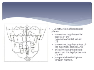  1. Construction of horizontal
planes
 one connecting the medial
aspects of the
zygomaticofrontal sutures
(Z);
 one connecting the centres of
the zygomatic arches (ZA);
 one connecting the medial
aspects of the jugal processes
(J); and
 one parallel to the Z-plane
through menton.
 