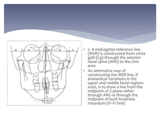  2. A midsagittal reference line
(MSR) is constructed from crista
galli (Cg) through the anterior
nasal spine (ANS) to the chin
area
 An alternative way of
constructing the MSR line, if
anatomical variations in the
upper and middle facial regions
exist, is to draw a line from the
midpoint of Z-plane either
through ANS or through the
midpoint of both foramina
rotundum (Fr-Fr line)
 