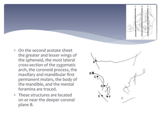  On the second acetate sheet
the greater and lesser wings of
the sphenoid, the most lateral
cross-section of the zygomatic
arch, the coronoid process, the
maxillary and mandibular first
permanent molars, the body of
the mandible, and the mental
foramina are traced.
 These structures are located
on or near the deeper coronal
plane B.
 