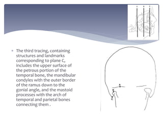  The third tracing, containing
structures and landmarks
corresponding to plane C,
includes the upper surface of
the petrous portion of the
temporal bone, the mandibular
condyles with the outer border
of the ramus down to the
gonial angle, and the mastoid
processes with the arch of
temporal and parietal bones
connecting them .
 