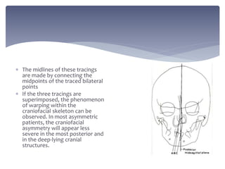  The midlines of these tracings
are made by connecting the
midpoints of the traced bilateral
points
 If the three tracings are
superimposed, the phenomenon
of warping within the
craniofacial skeleton can be
observed. In most asymmetric
patients, the craniofacial
asymmetry will appear less
severe in the most posterior and
in the deep-lying cranial
structures.
 