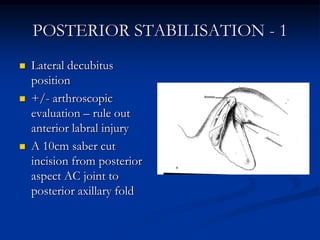POSTERIOR STABILISATION - 1Lateral decubitus position+/- arthroscopic evaluation – rule out anterior labral injuryA 10cm saber cut incision from posterior aspect AC joint to posterior axillary fold