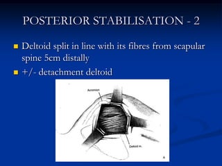 POSTERIOR STABILISATION - 2Deltoid split in line with its fibres from scapular spine 5cm distally+/- detachment deltoid