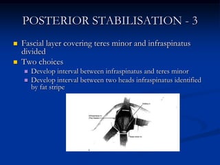 POSTERIOR STABILISATION - 3Fascial layer covering teres minor and infraspinatus dividedTwo choicesDevelop interval between infraspinatus and teres minorDevelop interval between two heads infraspinatus identified by fat stripe