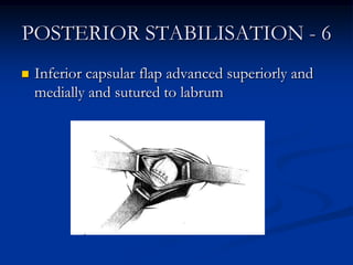 POSTERIOR STABILISATION - 6Inferior capsular flap advanced superiorly and medially and sutured to labrum