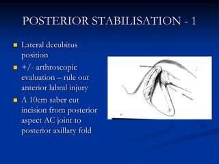 POSTERIOR STABILISATION - 1<br />Lateral decubitus position<br />+/- arthroscopic evaluation – rule out anterior labral in...