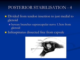 POSTERIOR STABILISATION - 4<br />Divided from tendon insertion to just medial to glenoid<br />beware branches suprascapula...
