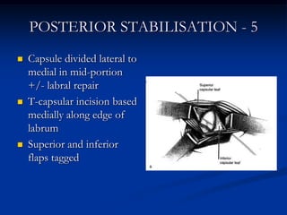 POSTERIOR STABILISATION - 5<br />Capsule divided lateral to medial in mid-portion +/- labral repair<br />T-capsular incisi...