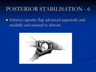 POSTERIOR STABILISATION - 6<br />Inferior capsular flap advanced superiorly and medially and sutured to labrum<br />
