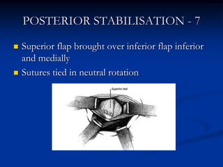 POSTERIOR STABILISATION - 7<br />Superior flap brought over inferior flap inferior and medially<br />Sutures tied in neutr...