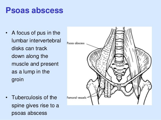 psoas-anal-line-action-teen-pregnancy