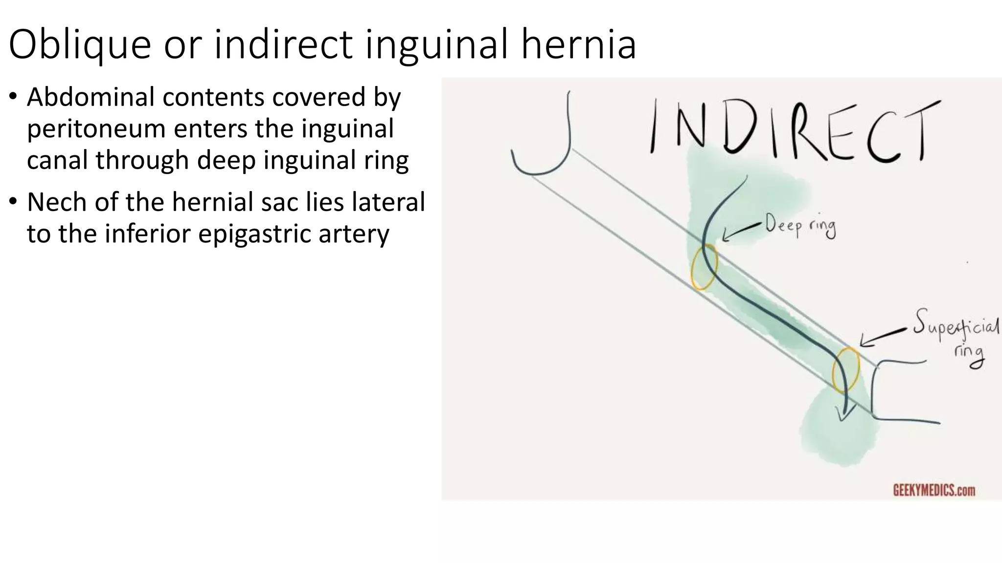 Oblique or indirect inguinal hernia
• Abdominal contents covered by
peritoneum enters the inguinal
canal through deep inguinal ring
• Nech of the hernial sac lies lateral
to the inferior epigastric artery
 