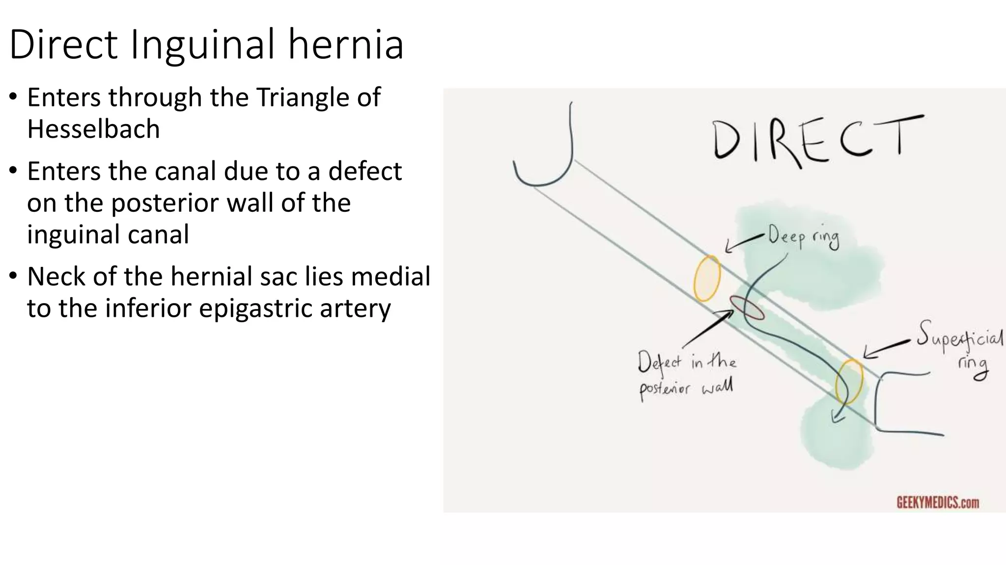 Direct Inguinal hernia
• Enters through the Triangle of
Hesselbach
• Enters the canal due to a defect
on the posterior wall of the
inguinal canal
• Neck of the hernial sac lies medial
to the inferior epigastric artery
 