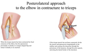 Posterolateral approach
to the elbow in contracture to triceps
When the triceps muscle has been contracted by fixed
extension of the elbow, free the aponeurosis
proximally to distally in a tongue-shaped flap and
retract it distally to its insertion
If the triceps muscle has not been contracted, divide
the muscle and aponeurosis longitudinally in the
midline and continue the dissection through the
periosteum of the humerus, through the joint capsule,
and along the lateral border of the olecranon
 