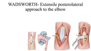 WADSWORTH- Extensile posterolateral
approach to the elbow
 