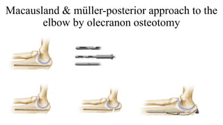 Macausland & müller-posterior approach to the
elbow by olecranon osteotomy
 