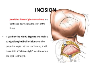 Moore Approach Posterior approach to the hip | PPTX